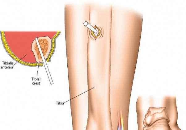 Illustration 35 for Expert Guide: Ulna and Wrist External Fixation Pin Placement
