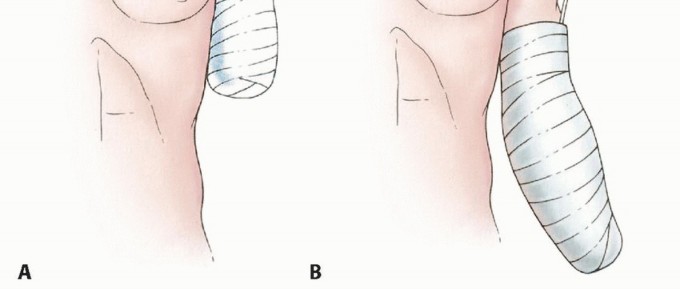 صورة طبية: بتر الذراع فوق وتحت الكوع: متى ولماذا يصبح ضرورة طبية؟ دليل شامل من الأستاذ الدكتور محمد هطيف