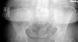 Illustration 10 for Mastering Direct Anterior Approach Hip Arthroplasty Without a Traction Table