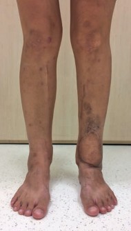 Illustration 34 for Decoding Pilon Fractures: Anterolateral and Medial Fragments Revealed