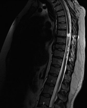 Illustration 4 for Mastering Hemivertebra Unilateral Bar Diagnosis: 12 Cases