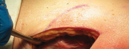 Illustration of minimally invasive tha - Dr. Mohammed Hutaif