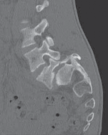 Mastering Posterolateral Arthrodesis for Spondylolisthesis