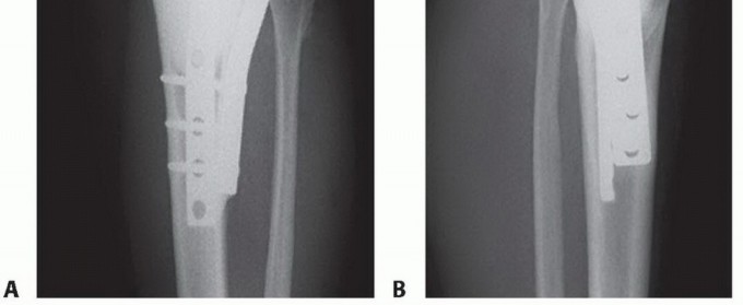 صورة طبية: تجنب الجراحة الكبرى: علاج أورام العظام بالنيتروجين السائل بتقنية الصب المباشر