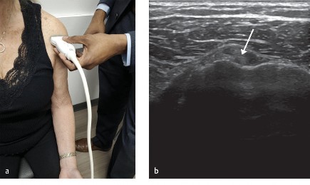 Shoulder Ultrasound: Patient & Probe for Efficient, Precise Scans