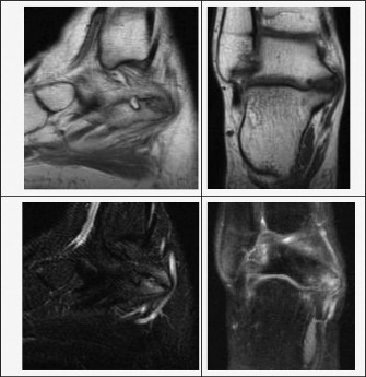 Illustration 4 for Pediatric Ankle Pain: Diagnosis Involves the Subtalar Joint