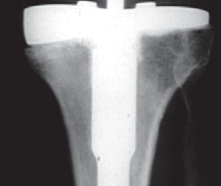 Illustration 31 for Revision of Failed UKA: Your Guide to Successful Treatment