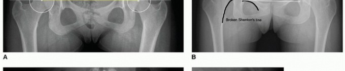 Illustration 6 for Periacetabular Osteotomy: Realigning your hip via the superior pubic ramus