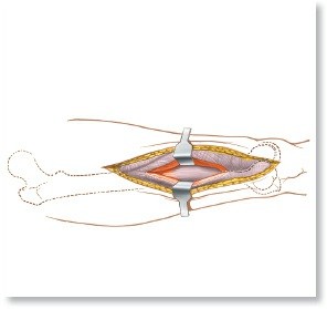 Optimal Femoral Approaches: Mastering the Lateral Intermuscular Septum