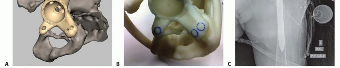 Illustration 11 for Pelvic Discontinuity: Understanding Superior and Inferior Separation