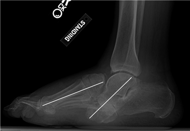 Illustration 122 for First Metatarsal Surgery: Expert Solutions for Foot & Ankle Pain
