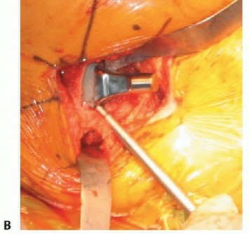 صورة طبية: نصف مفصل الورك: دليلك الشامل لدواعي الاستخدام والأنواع في صنعاء