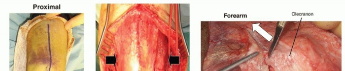 Surgical Approaches to the Elbow