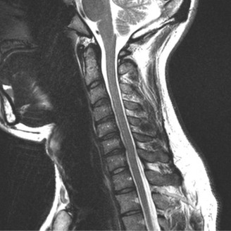 Illustration 26 for Adjacent Segment Degeneration: Your Next Spine Case Solved