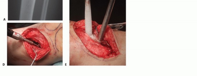 صورة طبية: تجنب الجراحة الكبرى: علاج أورام العظام بالنيتروجين السائل بتقنية الصب المباشر