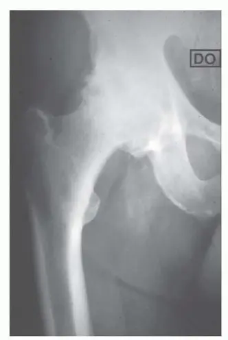 صورة توضيحية لـ استبدال مفصل الورك بدون أسمنت: استعادة الحركة والثبات في صنعاء مع الأستاذ الدكتور محمد هطيف