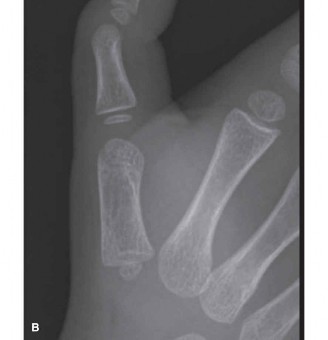 Illustration 5 for Orthopedic Hand Cases: A Patient's Journey, Is a Year Old a Factor?