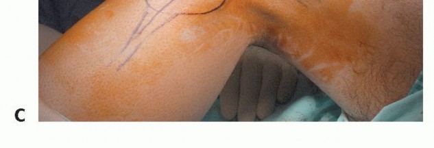 صورة مقطعية لورم في الشظية