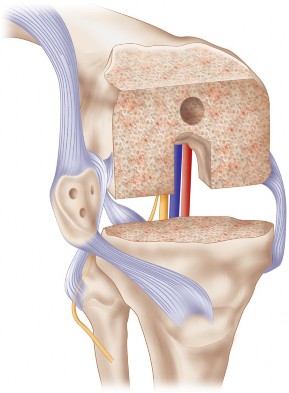Illustration 9 for Posterior Stabilized Technique: Essential Insights for TKA Success
