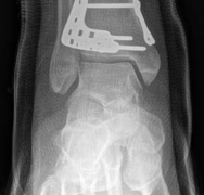 Illustration 19 for Complex Tibial Shaft Fracture: Plate Fixation for Plafond Extension
