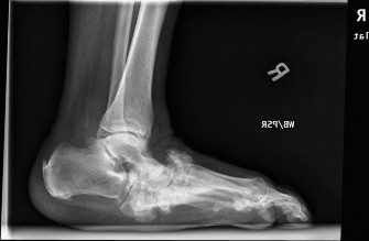 Charcot Foot vs. Infection: Spotting the Classic Rocker Bottom