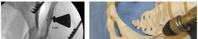 Illustration 16 for Periacetabular Osteotomy: Realigning your hip via the superior pubic ramus