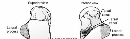 Illustration of talus fractures talus - Dr. Mohammed Hutaif