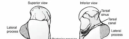 صورة توضيحية لـ كسور عظم الكاحل (القدم): دليل شامل للمرضى في اليمن والخليج