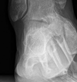 Illustration 12 for Partial Articular Fractureplate Fixation: Restore Anatomy