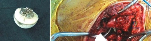 Unlocking Optimal Hip Implants: Metal on Metal Choices Explained