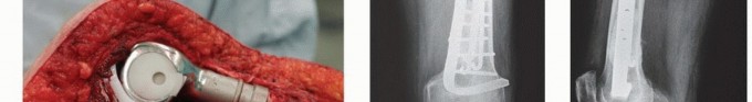 صورة طبية: النقائل العظمية الفخذية: دليل شامل للعلاج واستعادة الوظيفة مع الأستاذ الدكتور محمد هطيف في صنعاء
