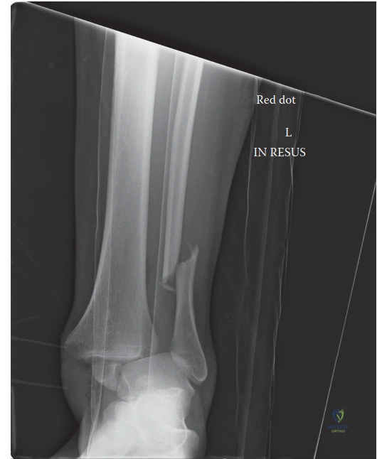 Complex Ankle Fracture Case Study: PER Stage IV & Posterior Malleolus Management