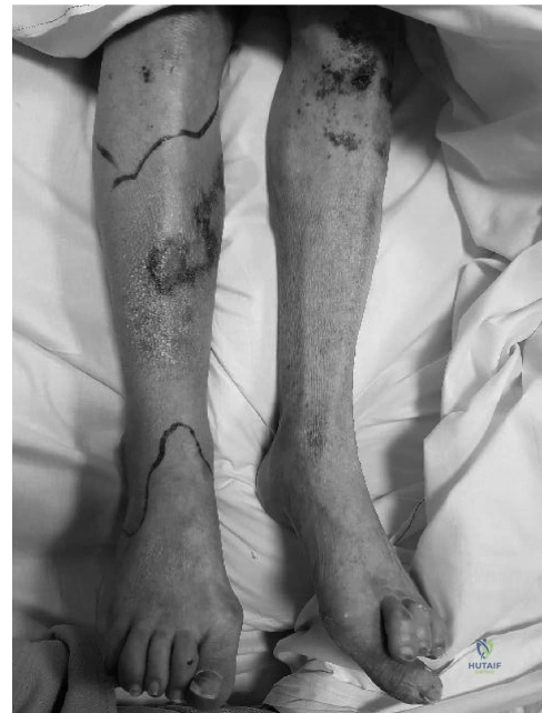 Illustration of case infected ankle - Dr. Mohammed Hutaif