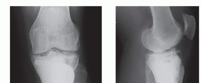 صورة طبية: تجنب الجراحة الكبرى: علاج أورام العظام بالنيتروجين السائل بتقنية الصب المباشر