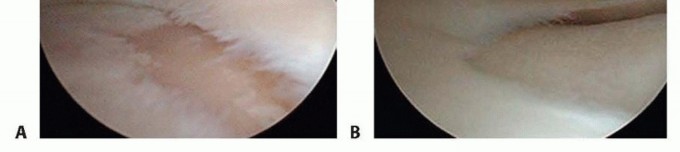 Illustration 8 for High Tibial Osteotomy: Realignment for Lasting Knee Pain Relief