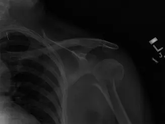 صورة توضيحية لـ كسر عظم العضد: دليل شامل للعلاج والتعافي مع الأستاذ الدكتور محمد هطيف في صنعاء