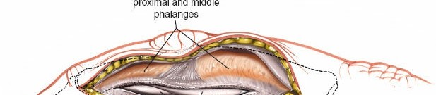 Illustration 165 for Essential Surgical Approaches: Uncover Every Aspect of the Wrist