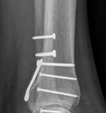 Illustration 13 for Partial Articular Fractureplate Fixation: Restore Anatomy