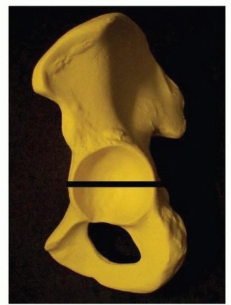 Pelvic Discontinuity: Understanding Superior and Inferior Separation