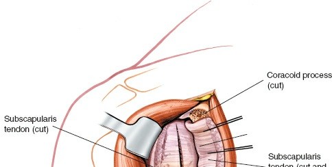 Illustration 33 for Essential Guide: Mastering Every Approach to the Shoulder