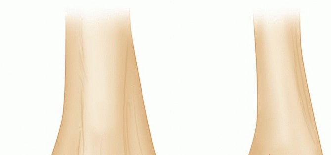 Illustration of capitellartrochlear shear fractures - Dr. Mohammed Hutaif