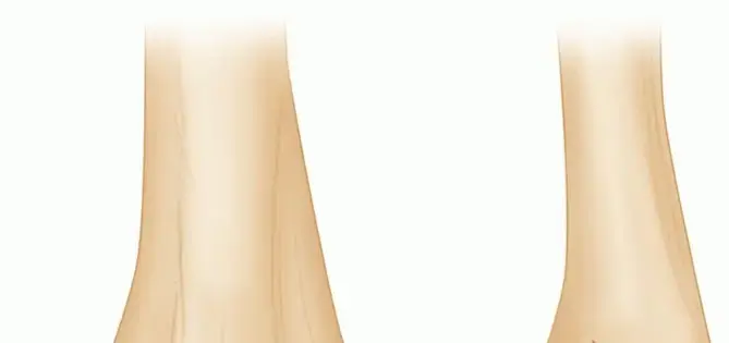 صورة توضيحية لـ دليل شامل لكسور اللقمة ومفصل المرفق المعقدة: العلاج والتعافي مع الأستاذ الدكتور محمد هطيف