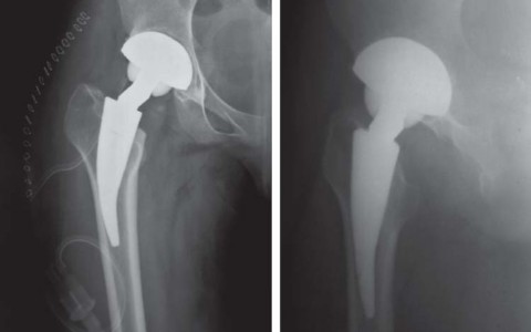 صورة طبية: مفصل الفخذ الصناعي قصير الجذع METHA: حلول مبتكرة للحفاظ على العظم في صنعاء مع الأستاذ الدكتور محمد هطيف