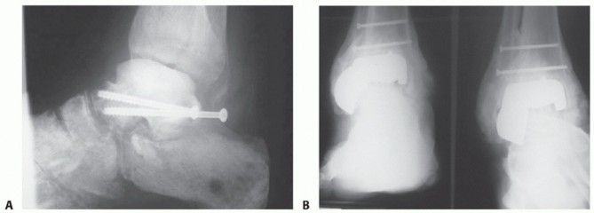Severe Talar Defects? Explore the Femoral Head Graft Option