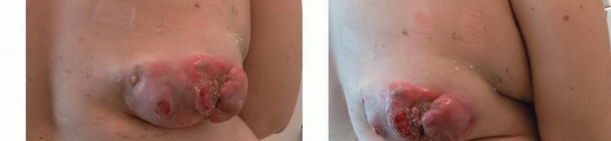 صورة طبية: الاستئصال الموجه لأورام الجهاز العضلي الهيكلي: نهج أكثر أمانًا وفعالية مع الأستاذ الدكتور محمد هطيف