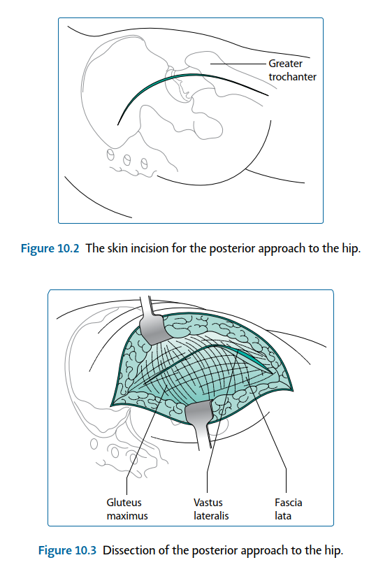 Illustration 5 for Mastering Short External Rotators for Optimal Hip Surgery Results