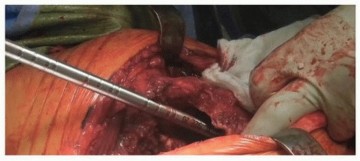 Illustration 3 for Optimizing Revision THA with Tapered Fluted Titanium Stems