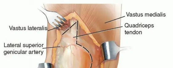 صورة توضيحية لـ بسط العضلة الرباعية بتقنية V-Y: حلول الأستاذ الدكتور محمد هطيف لتعقيدات جراحة الركبة