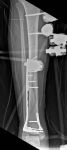 Illustration 14 for Complex Tibial Shaft Fracture: Plate Fixation for Plafond Extension