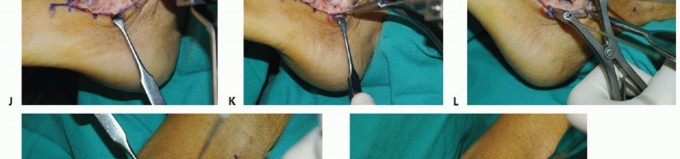 Illustration of isolated subtalar arthrodesis - Dr. Mohammed Hutaif